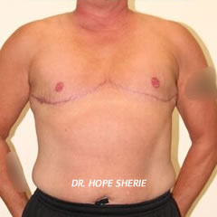 Double Incision Top Surgery