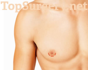 Keyhole Top Surgery