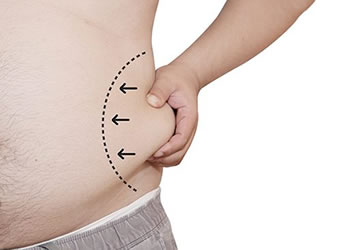 Demystifying Liposuction Body Sculpting